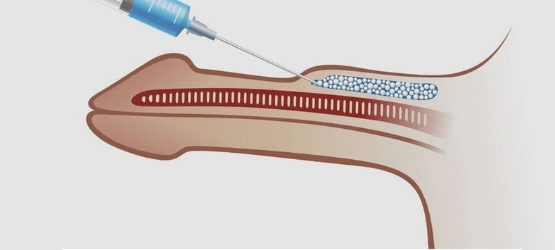 penile injection